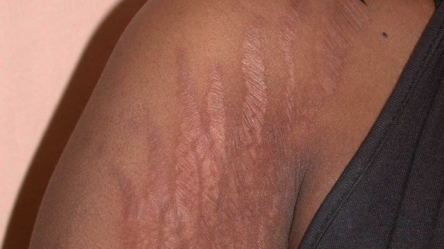 Getting Rid Of Stretch Marks The Fastest And Easiest Way!