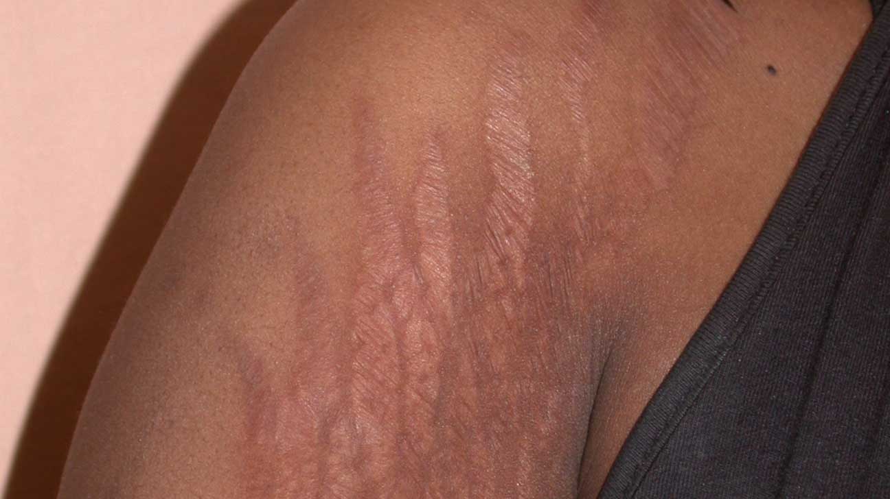 Getting Rid Of Stretch Marks The Fastest And Easiest Way!